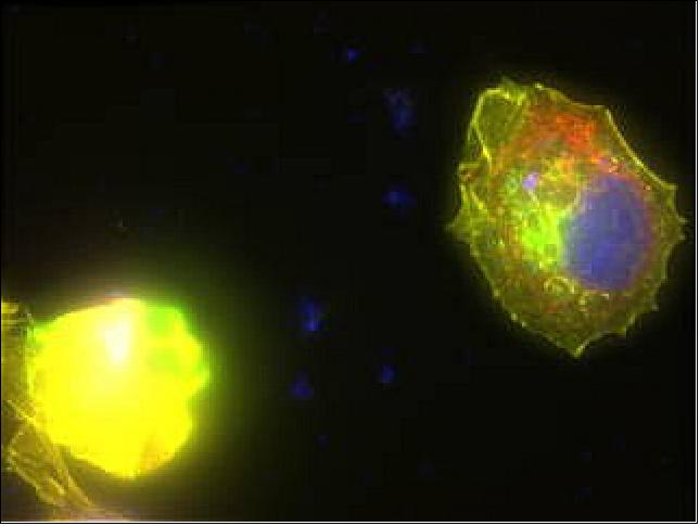 Figure 5: This image shows immunofluorescence of breast cancer cells treated with a MicroQuin therapeutic. Staining shows a normal nucleus (blue) and the therapeutic (green) localized to the cell's endoplasmic reticulum (red). The drug forces the cytoskeleton (yellow) to collapse, inducing cell death (image credits: Scott Robinson, MicroQuin)